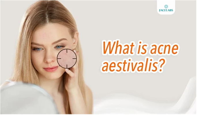 What Is Acne Aestivalis? - FACELABS THAILAND