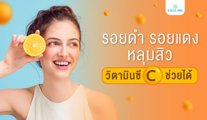 รอยดำ รอยแดง หลุมสิว วิตามินซีช่วยได้ - Facelabs Thailand