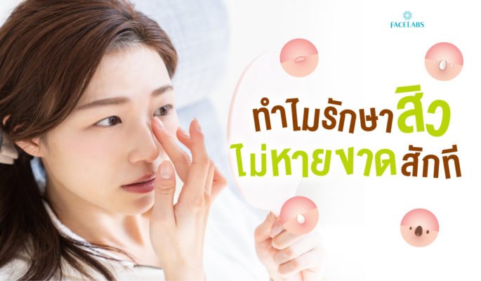 ทำไมรักษาสิวไม่หายขาดสักที