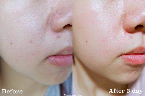 [:th]Acne-Lotion-KN_Shappo[:]