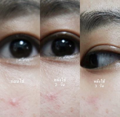 [:th]Acne-Lotion-jellllnrr[:]