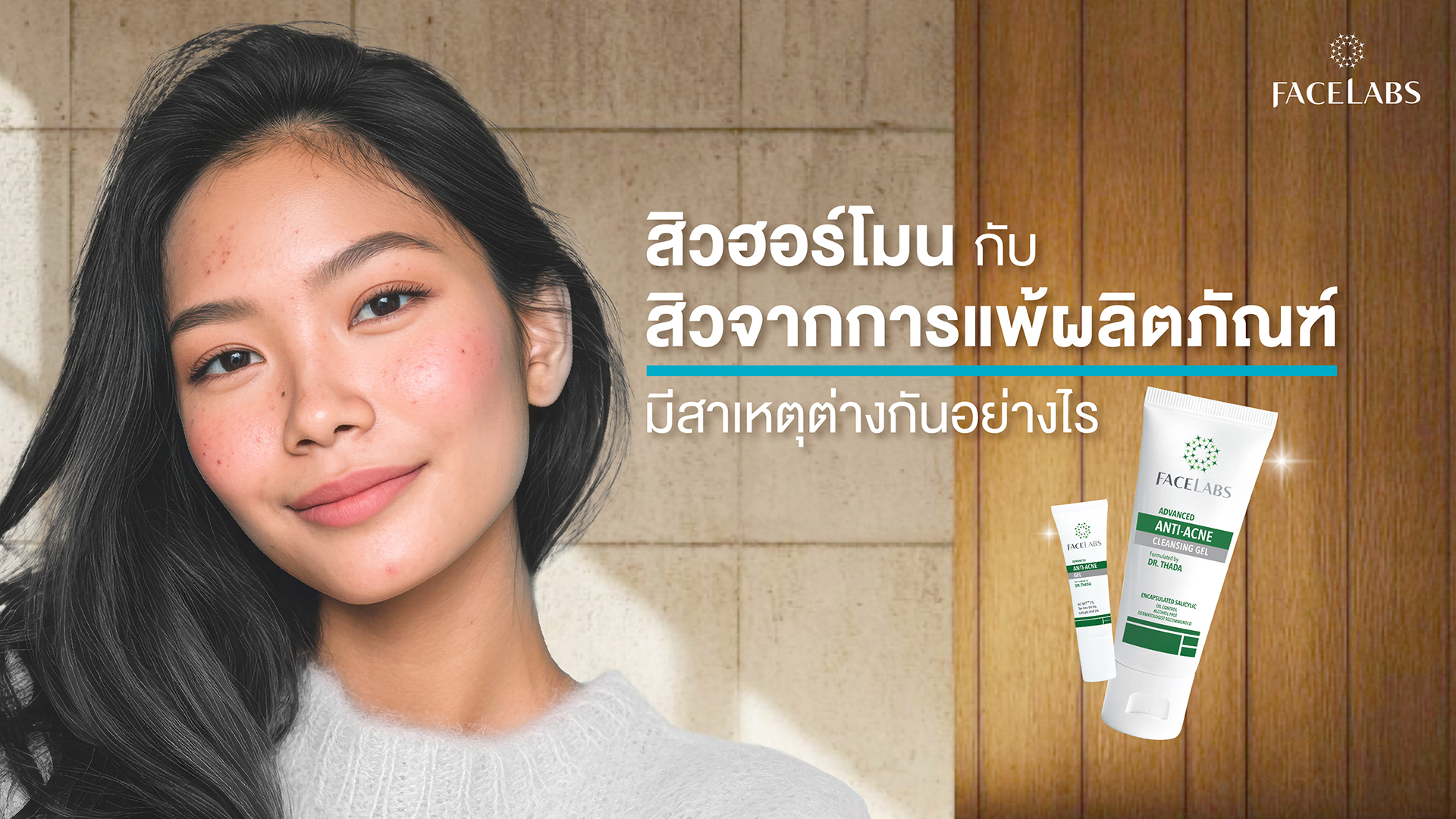 สิวฮอร์โมน